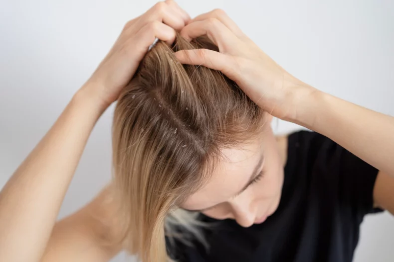 cabelo com caspa